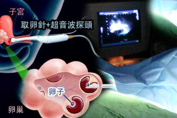 昆明找人做代孕多少钱,试管婴儿的具体操作步骤_上海三代试管婴儿的费用大约